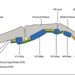 Fleksör Tendon Zone 2 Yaralanmaları