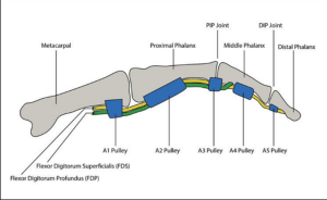 Fleksör Tendon Zone 2 Yaralanmaları