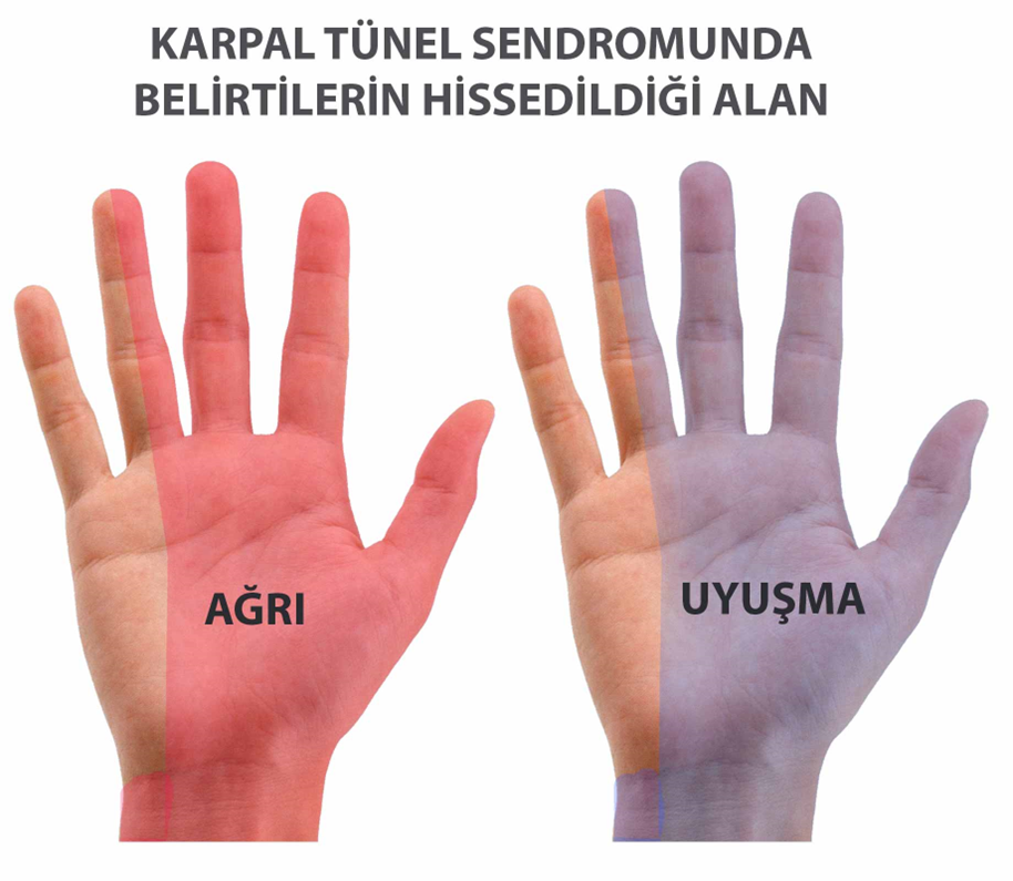 Karpal Tünel Sendromu